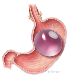 Orbera non-surgical weight loss solution
